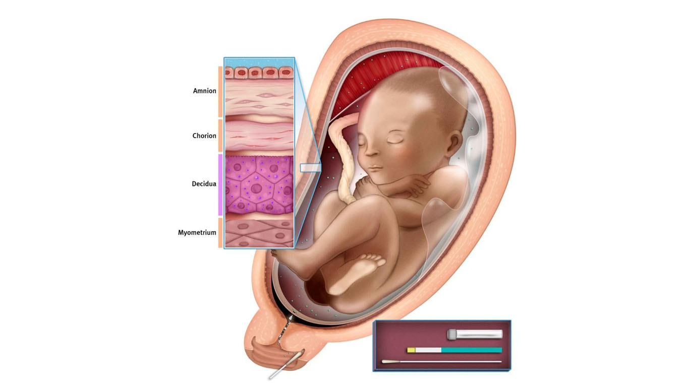 Diagnosis Ketuban Pecah Dini
