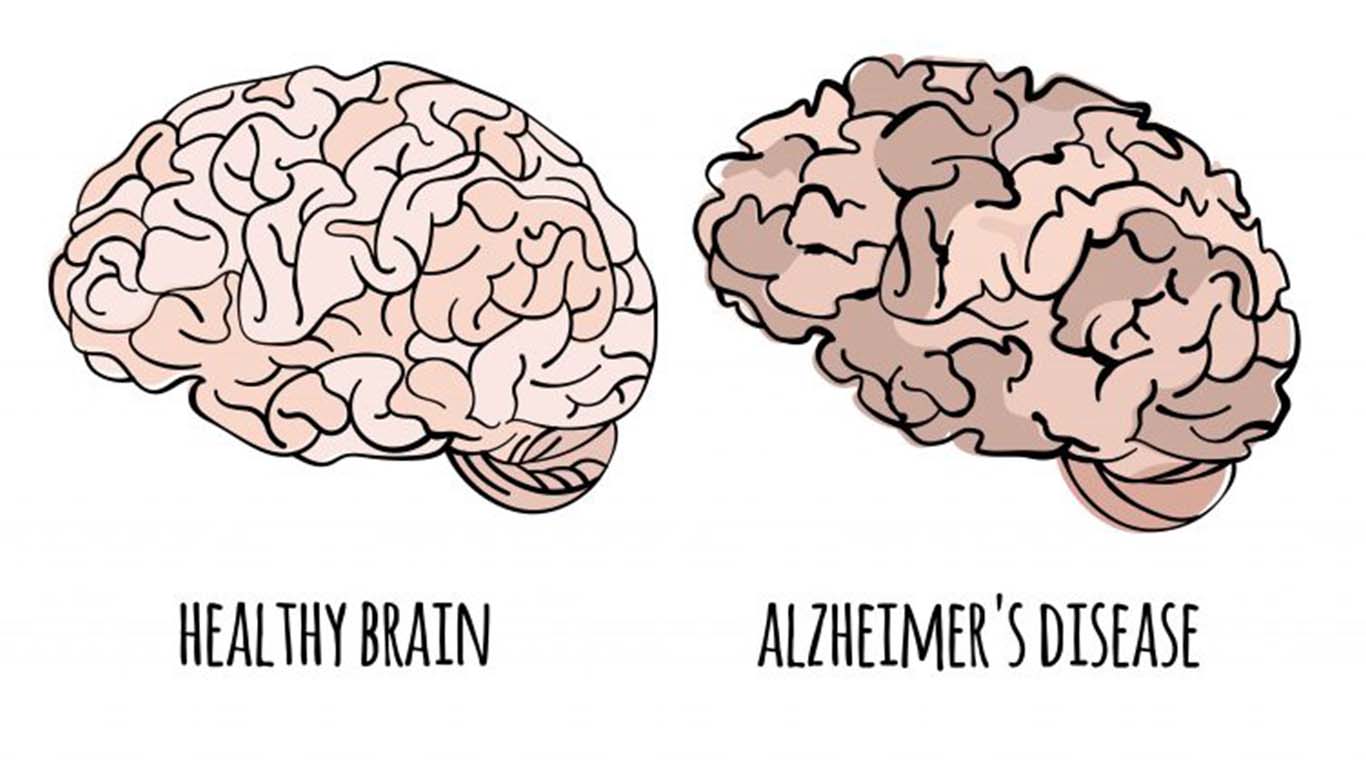 Ilustrasi perbedaan otak penderita Alzheimer dengan orang normal