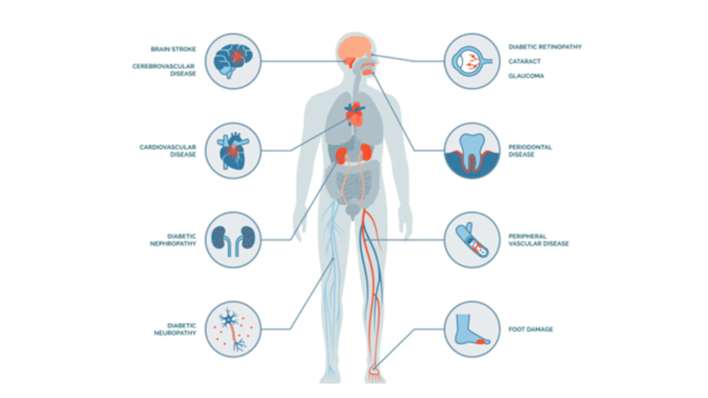 Komplikasi Diabetes. Sumber: Endocrine Society.