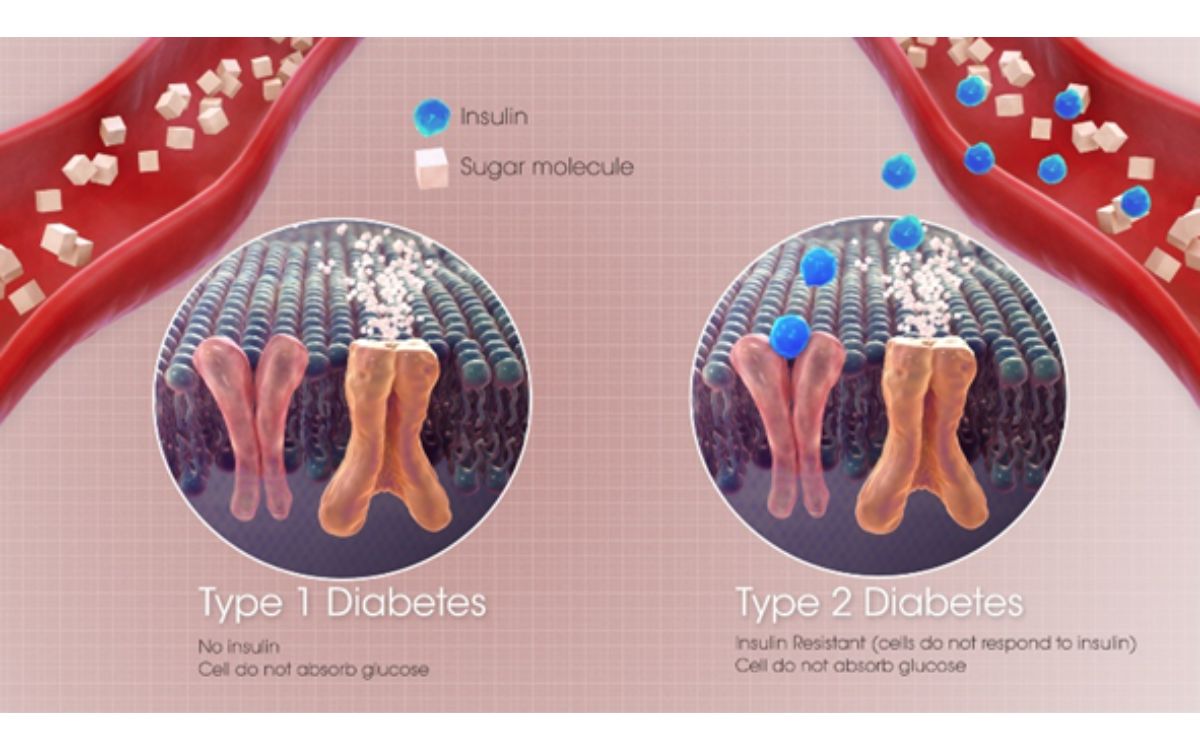Ilustrasi perbedaan antara diabetes tipe 1 dan tipe 2
