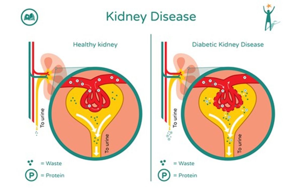 Perbedaan ginjal sehat dengan yang mengalami diabetes