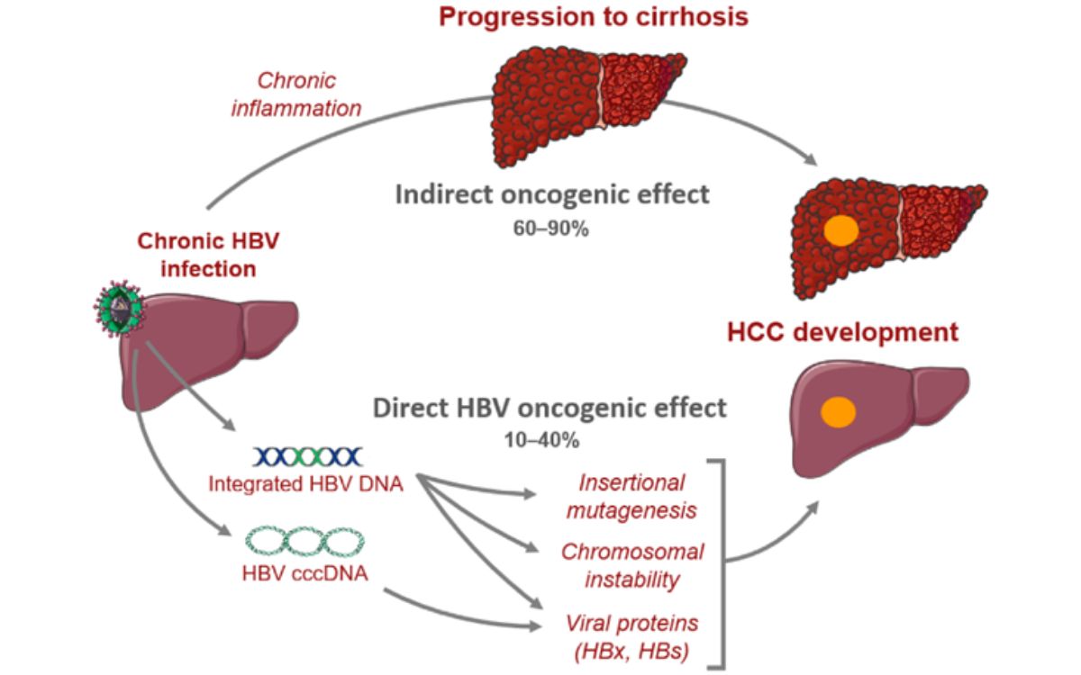 Perkembangan penyakit hepatitis menjadi sirosis dan kanker hati. Sumber: MDPI.