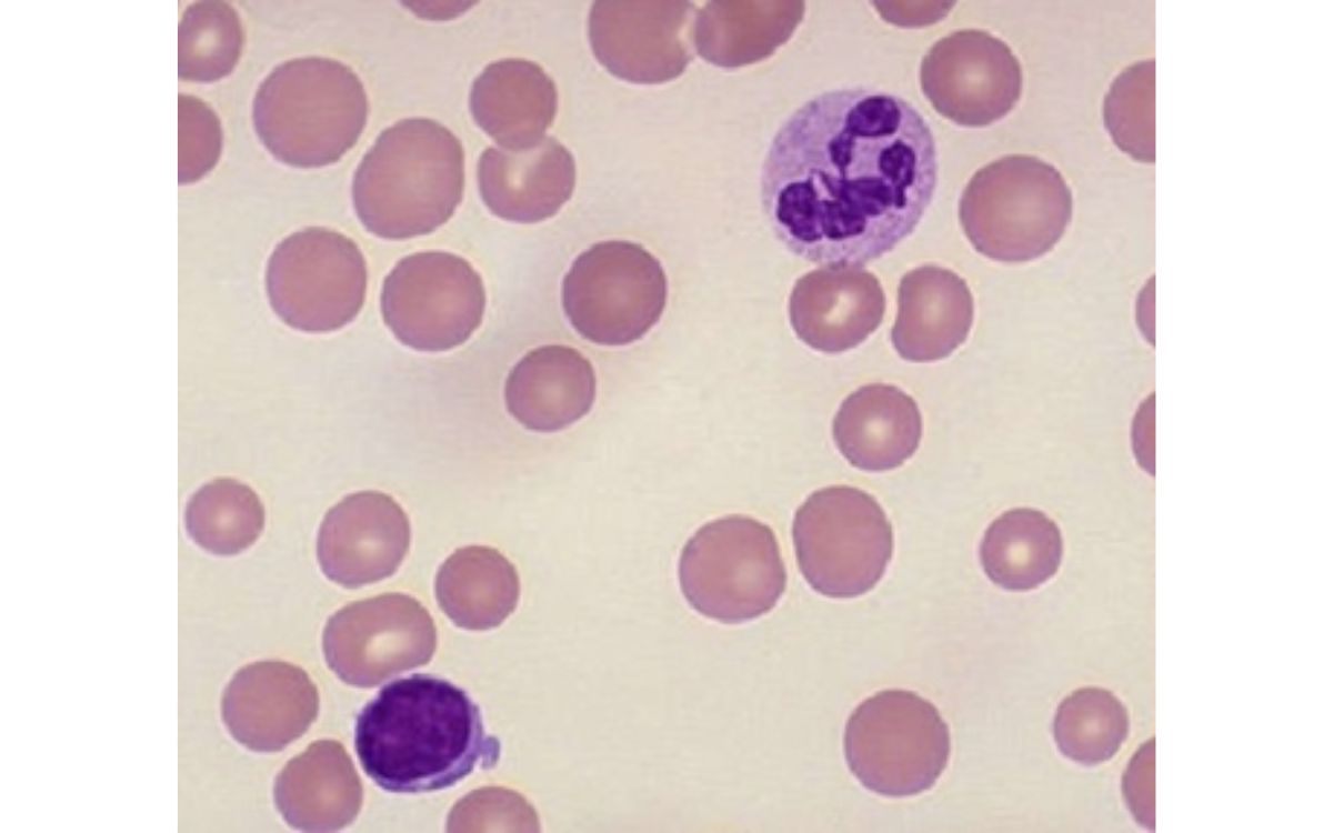 Gambar sel darah merah anemia makrositik. Sumber: NCBI.