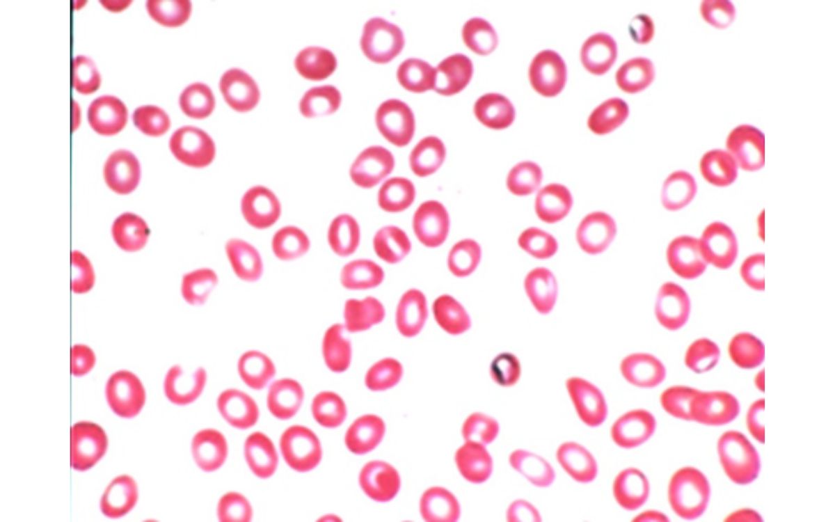 Gambar sel darah merah mikrositik anemia. Sumber: NCBI.
