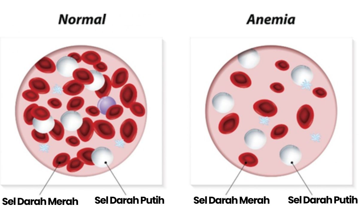 Ilustrasi kondisi Normal vs Anemia. Sumber: Health Harvard.