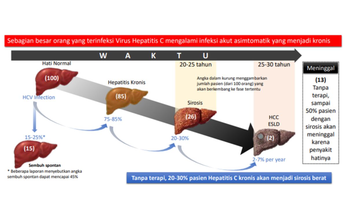 Ilustrasi perkembangan penyakit hepatitis menjadi sirosis dan kanker hati.