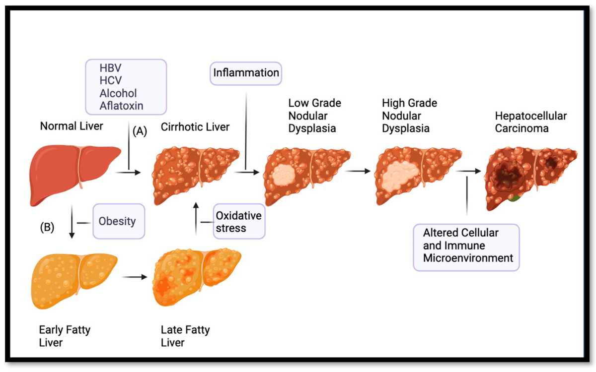 Diagram sederhana yang menguraikan mekanisme utama patogenesis karsinoma hepatoseluler (HCC).