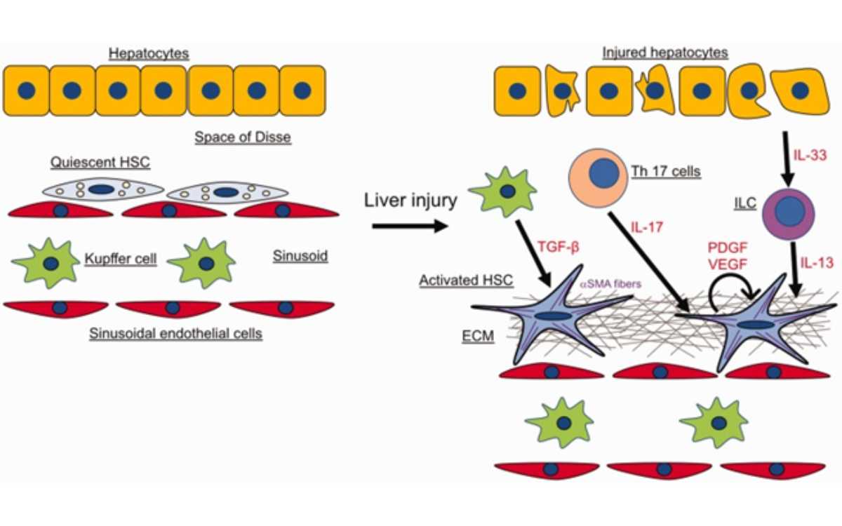 Patofisiologi hati yang mengalami fibrosis.