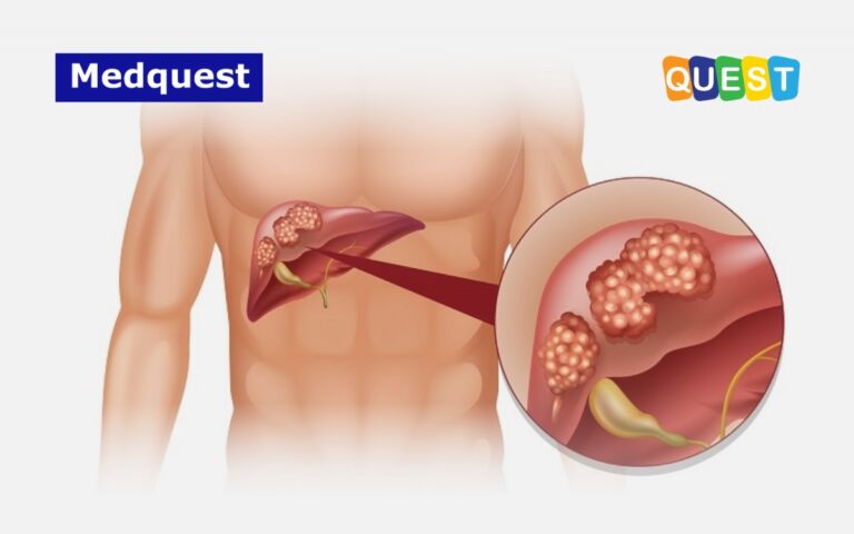 Thumbnail Karsinoma Hepatoseluler Komplikasi Paling Berbahaya Fibrosis Hati.
