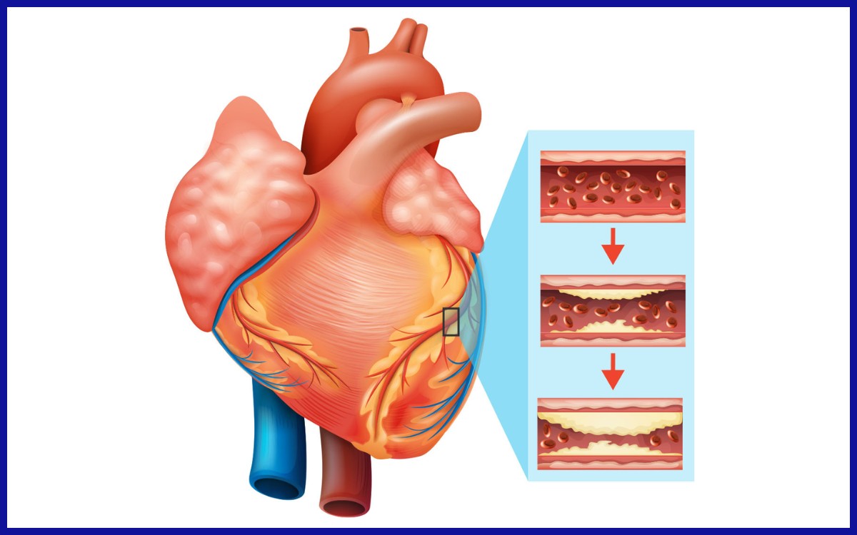 Penumpukan plak pada arteri koroner.