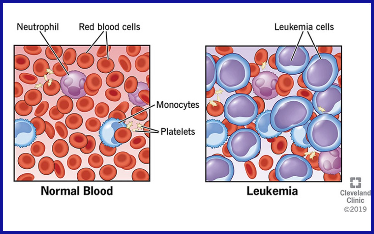Perbedaan darah normal dengan darah penderita leukemia