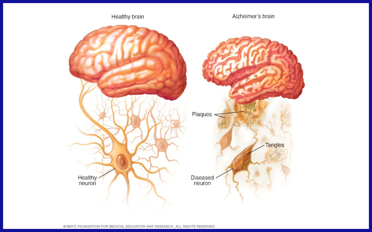 Perbedaan otak sehat dan otak dengan penyakit alzheimer