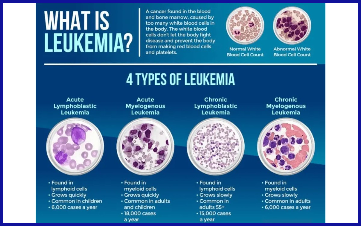 Tipe-tipe leukemia