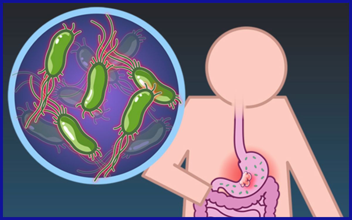 Ilustrasi helicobacter pylori penyebab kanker lambung. Sumber: The New England Journal Of Medicine.