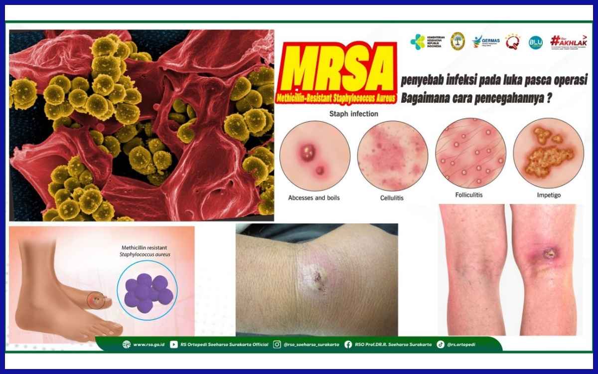 Ilustrasi infeksi MRSA