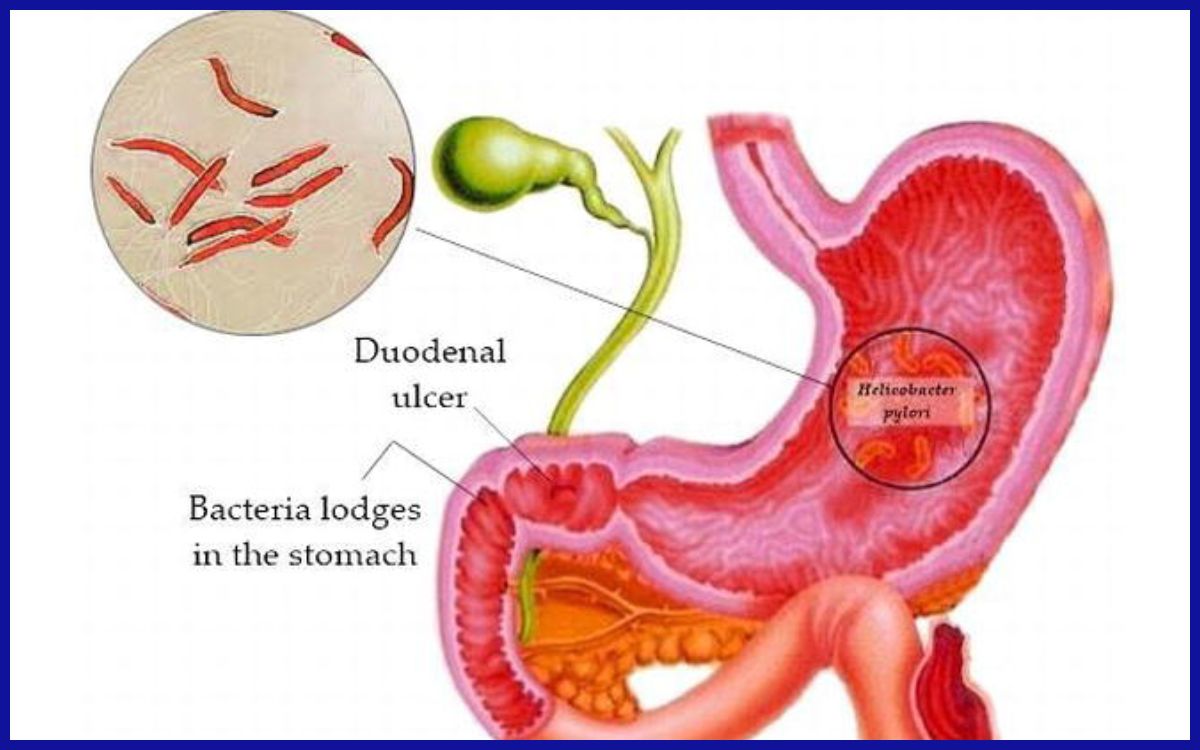 Ilustrasi lokasi infeksi H. pylori di dalam lambung